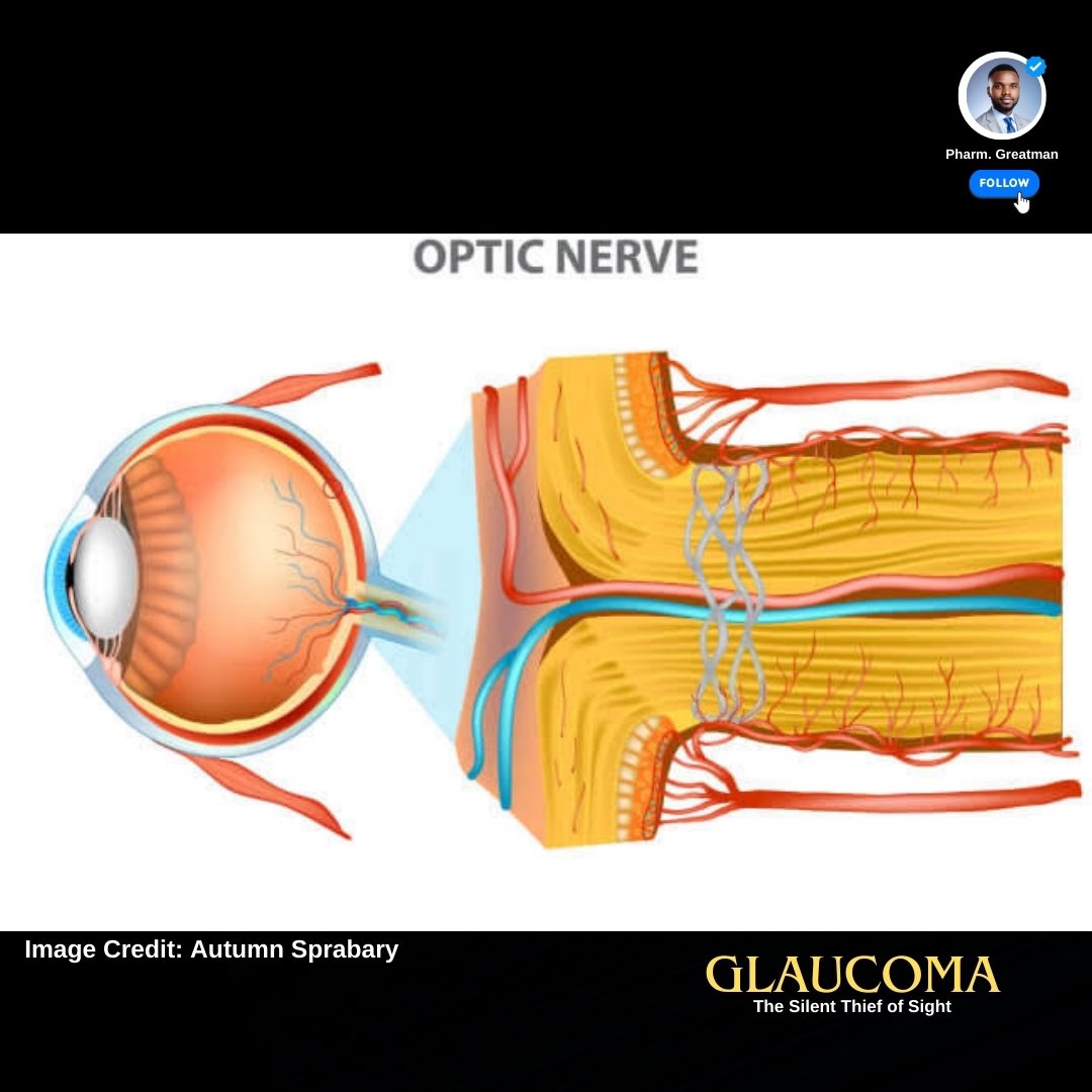 Glaucoma 