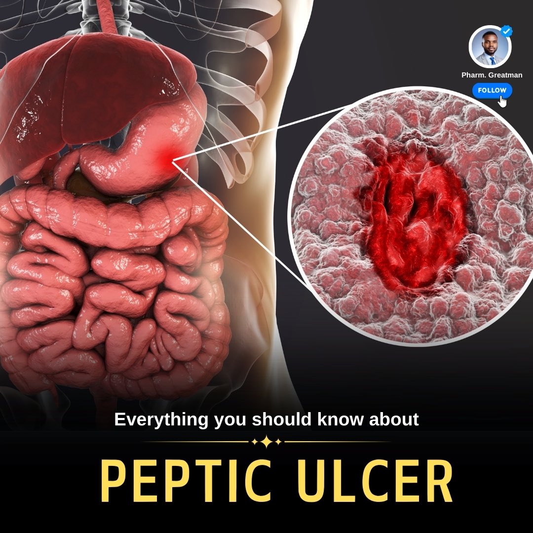 Peptic ulcer